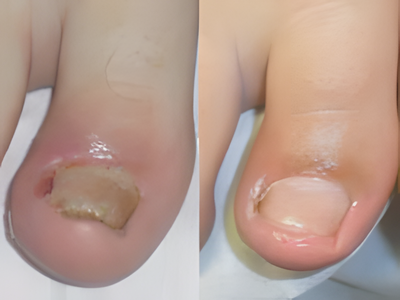 Before and after photo of a client's toenail treated with Fungomer Nail Elixir