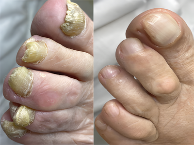 Client's toenails treated with Fungomer Nail Elixir before and after